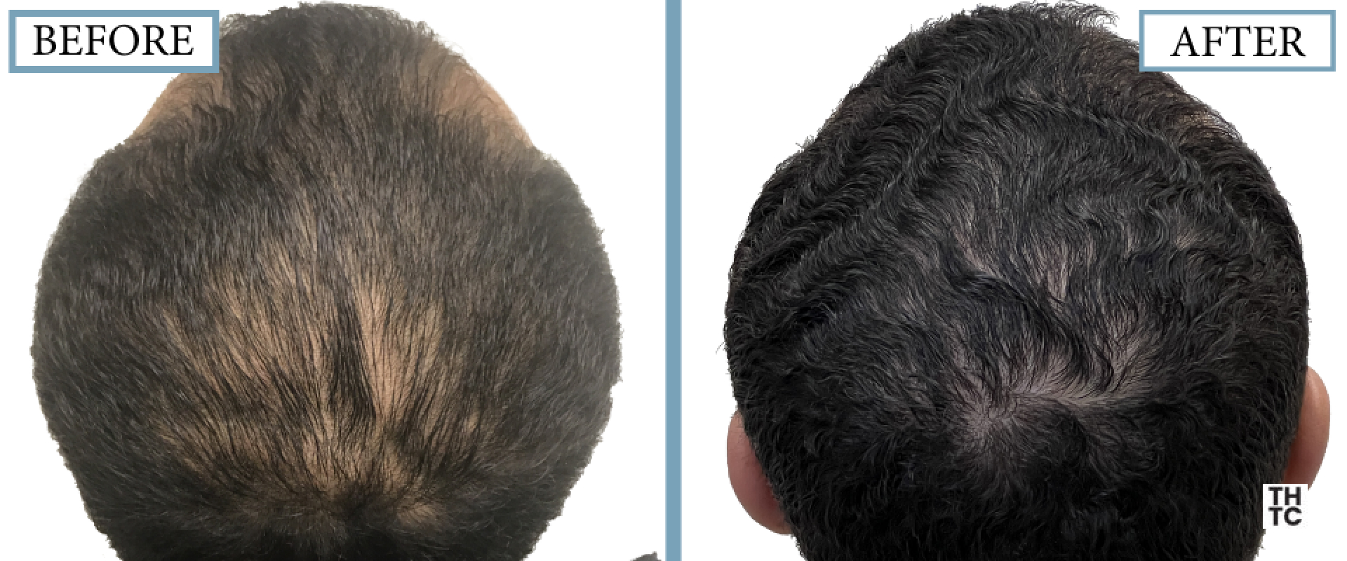 Hair Transplant Toronto